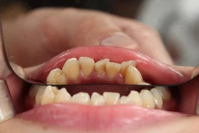 Quando preciso fazer uma restauração?