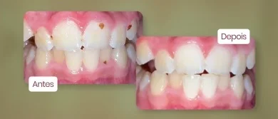Limpeza dentária/Profilaxia