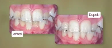 Limpeza dentária/Profilaxia
